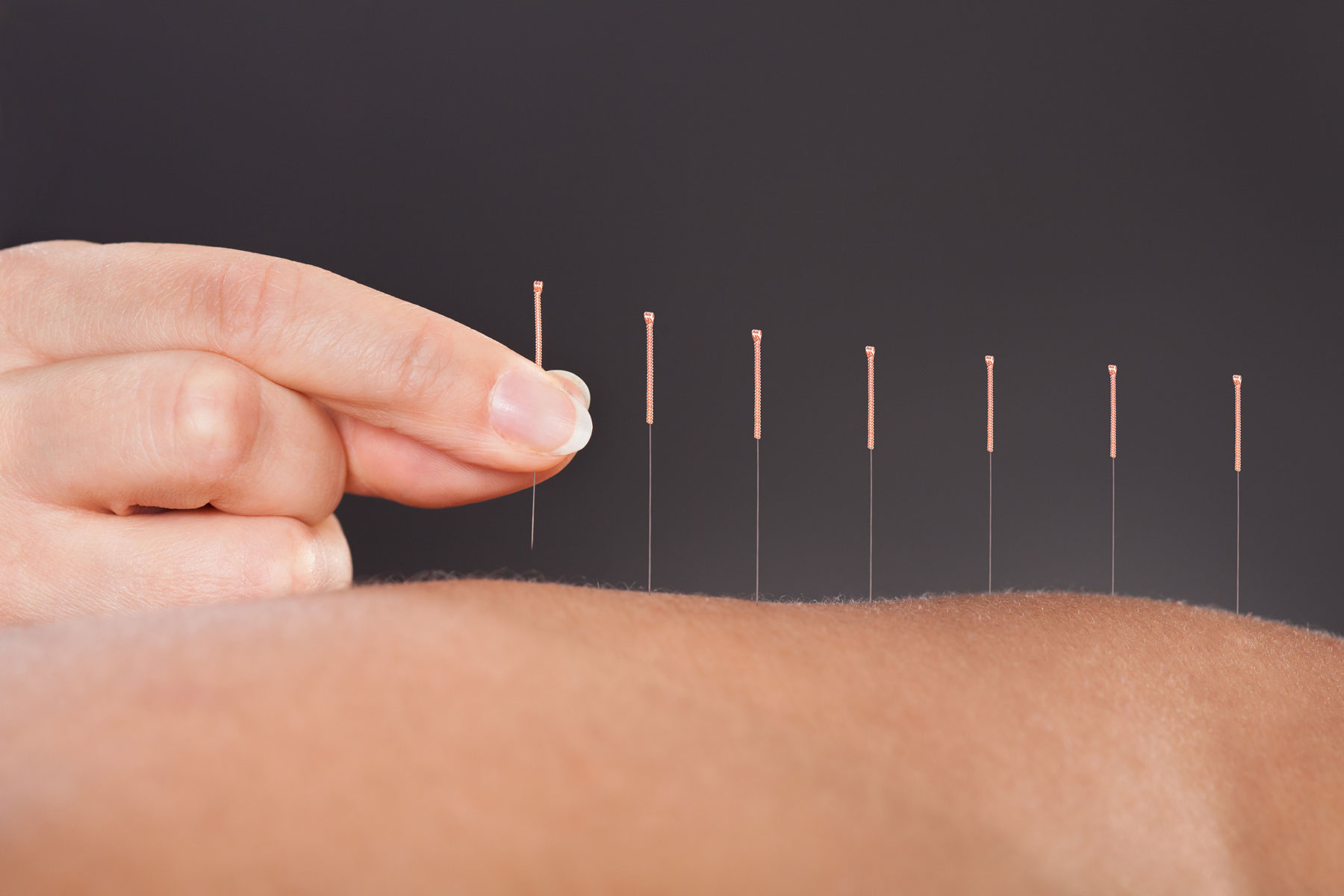 Musculoskeletal Pain and Acupuncture in Phoenix & Mesa