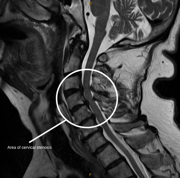 imaging of cervical spinal stenosis